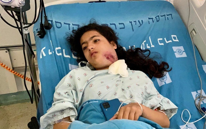  الطفلة الفلسطينية منوّر برقان – “صماء”  …قنبلة صوتية اسرائيلية تسبب لها كسور في الوجه