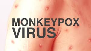  كيف يجب أن نكون خائفين من جذري القرودHOW SCARED SHOULD WE BE OF MONKEYPOX