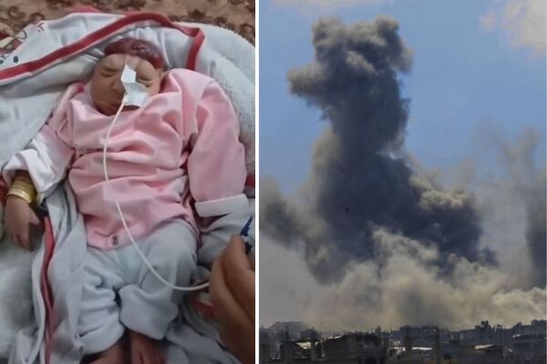 ولادة طفلة “بلا دماغ” مع تزايد ظاهرة “تشوه الأجنة” في قطاع غزة