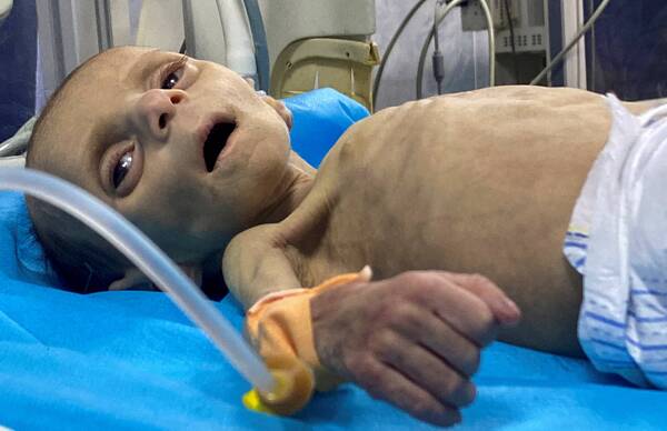 غزة: 112 طفلا يدخلون المستشفيات يوميا بسبب سوء التغذية