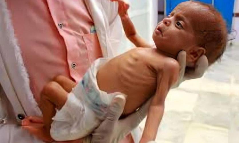 “الأونروا”: أكثر من 2700 طفل في غزة أصيبوا بسوء تغذية حاد
