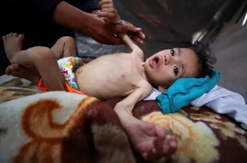  اليونيسيف: سوء التغذية يهدد صحة الأطفال في غزة