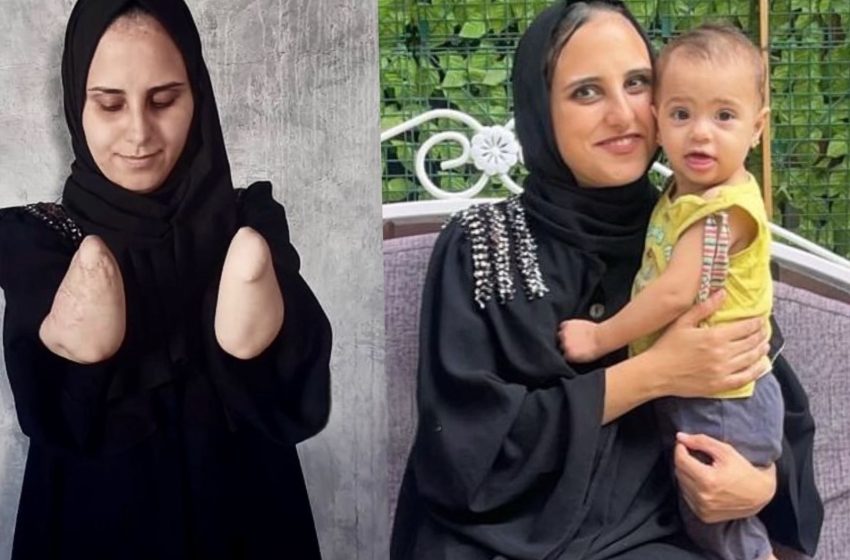  أم فلسطينية فقدت يديها في قصف إسرائيلي تكافح لرعاية طفلتها