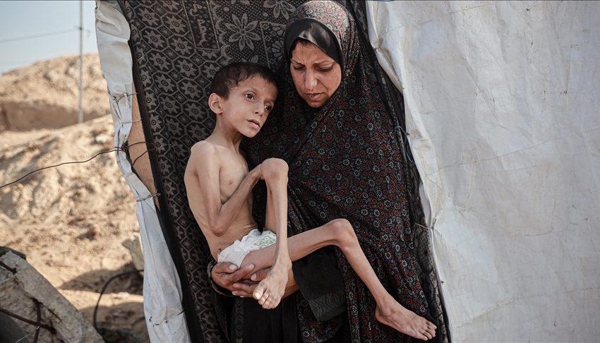  الأمم المتحدة: عدد حالات سوء التغذية الحاد بغزة ارتفع إلى 95 ألفا