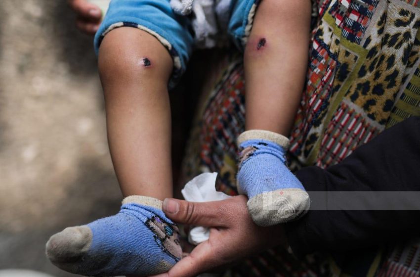  تنديد أمريكي واسع بجريمة تعذيب رضيع فلسطيني بـ’المسامير والسجائر’ في غزة