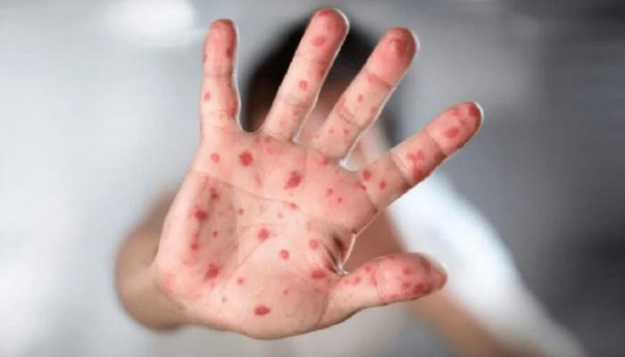  Measles Resurgence in the United States Raises Alarm Over Vaccine Misinformation and Public Health Cuts